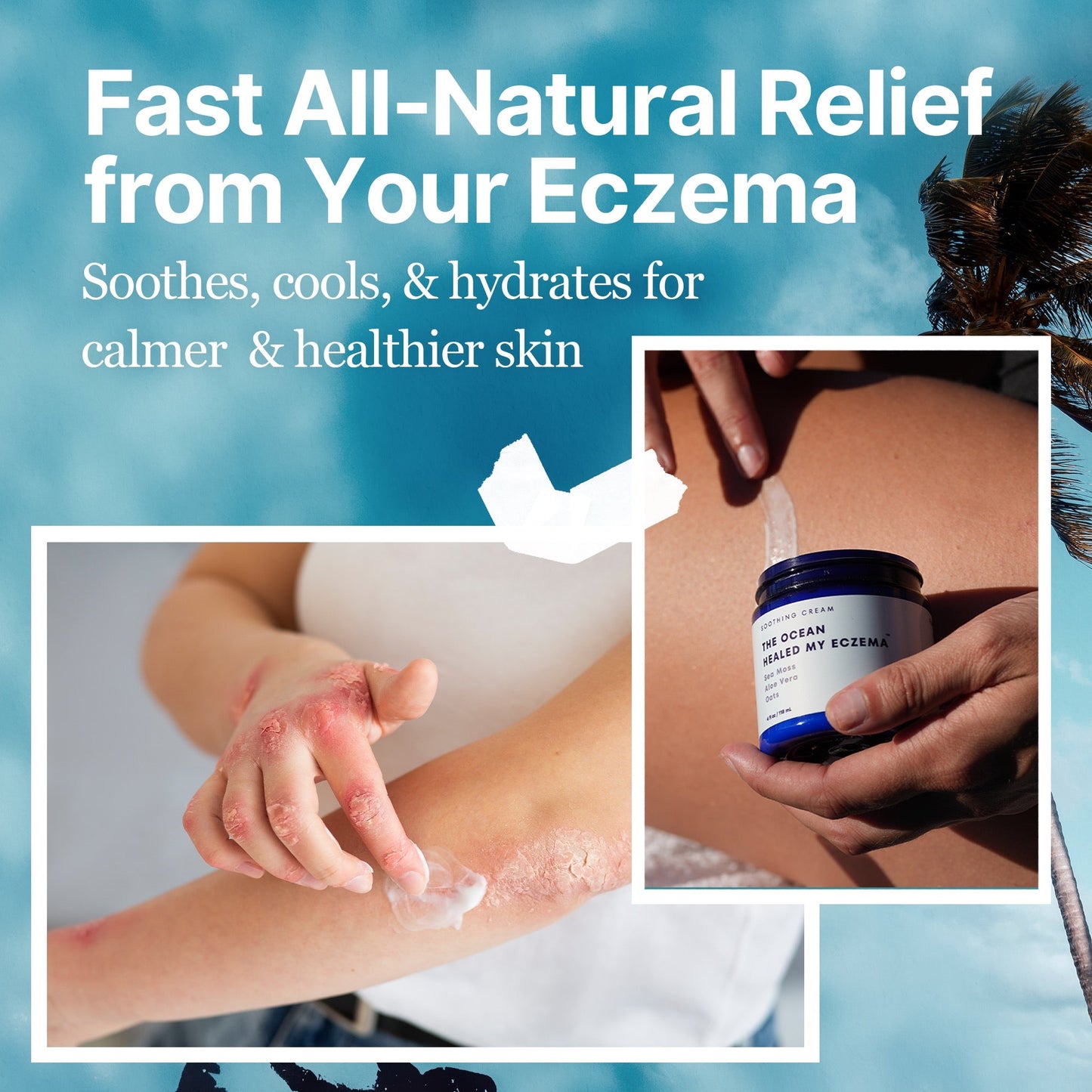 The Ocean Healed My Eczema – Soothing Cream by SeaSkin Naturals™