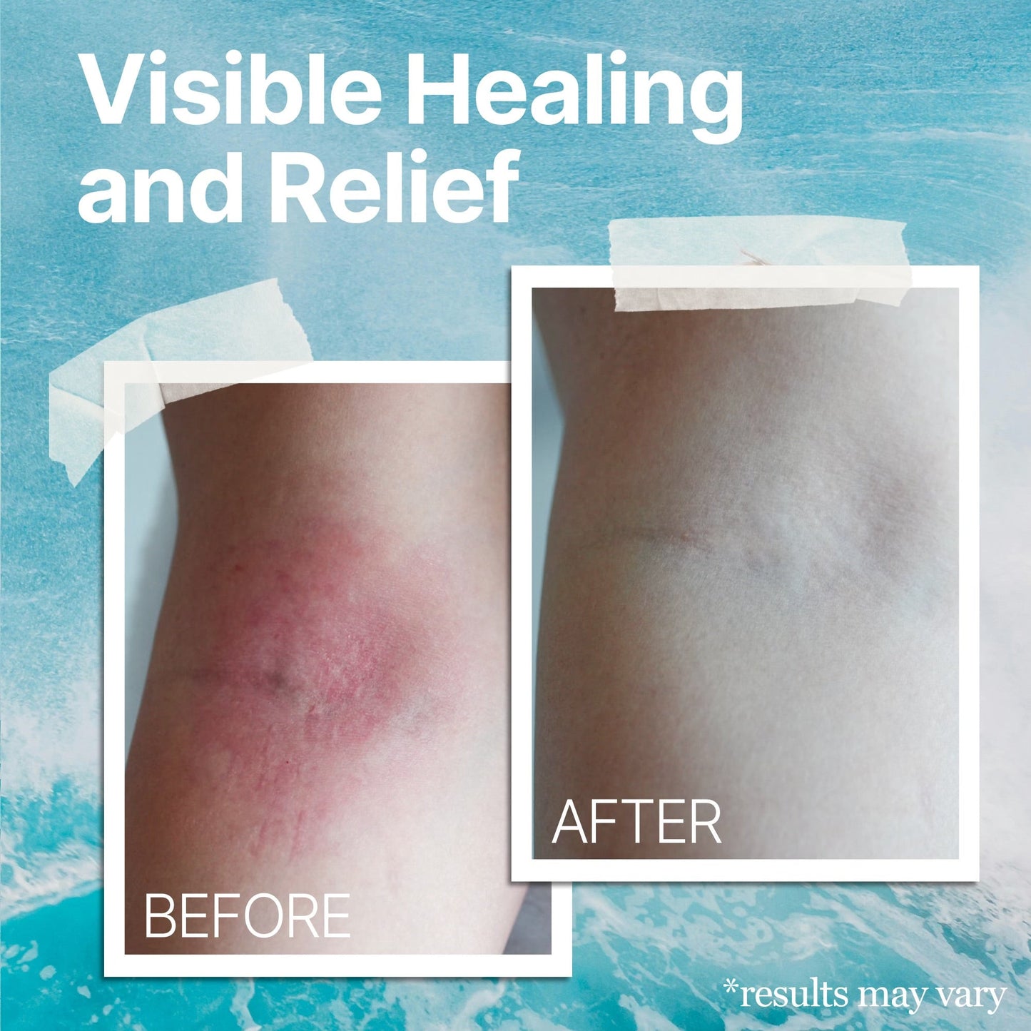 The Ocean Healed My Eczema – Soothing Cream by SeaSkin Naturals™